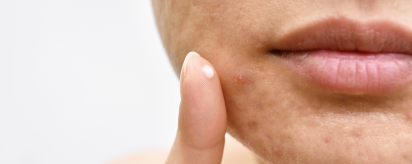Πώς να Αντιμετωπίσετε την Ακμή: Συμβουλές και πρακτικές για υγιές δέρμα
